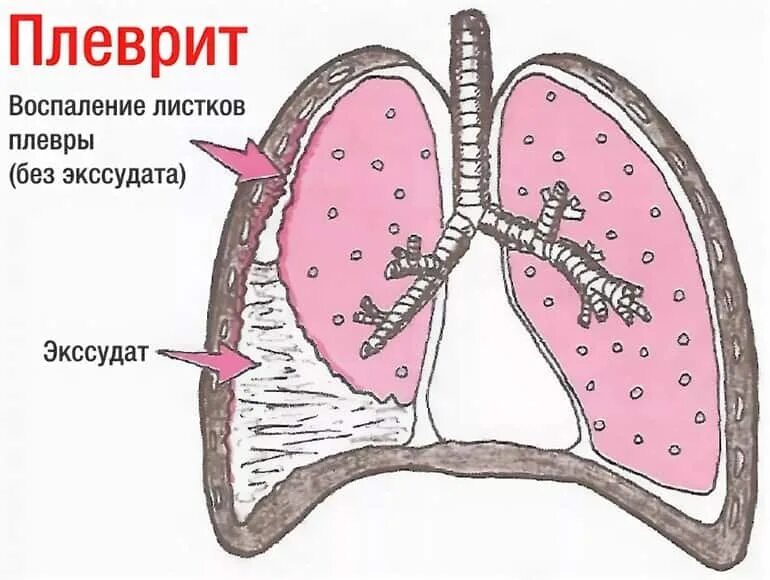 Плеврит воспаление плевры. Сухой фибринозный плеврит. Плевральный выпад и плеврит. Туберкулезный плеврит гистология.