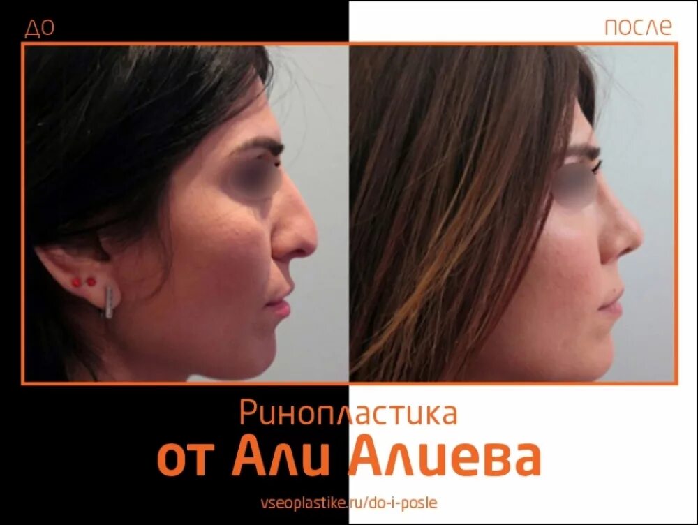 неудачная ринопластика. алиев али ринопластика. алиев пластический хирург отзывы. джеймс мак пластическая операция. алиев пластический хирург отзывы.