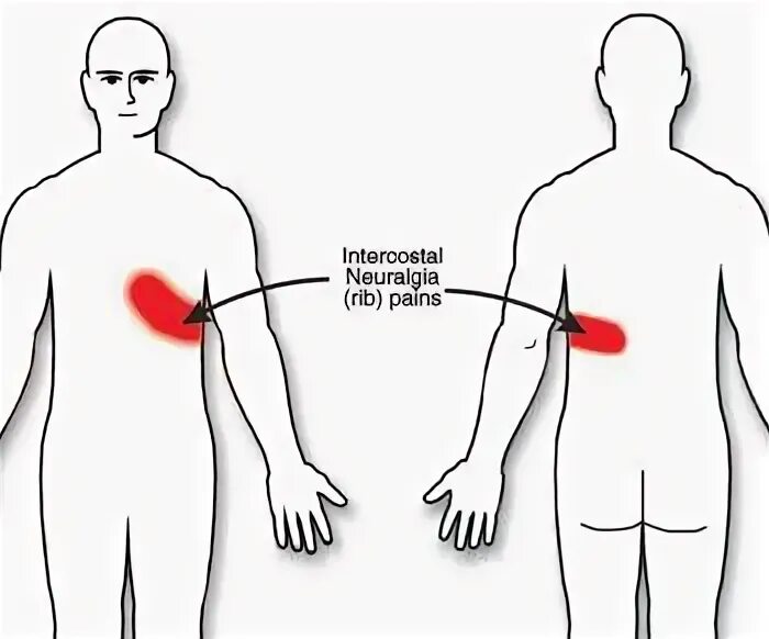 Межреберная невралгия иррадиация боли. Межреберная невралгия грудной клетки. Локализация боли при невралгии. Ноющая боль в груди с левой стороны. Иррадиация чувств