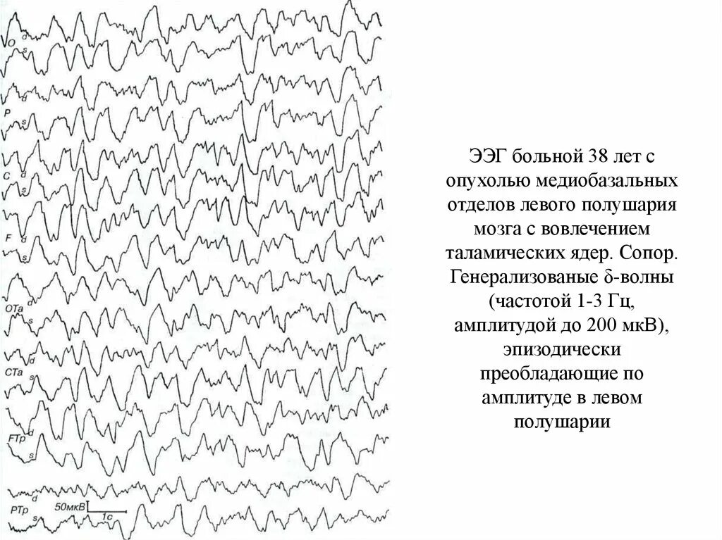 О чем говорит ээг. ЭЭГ при опухоли головного мозга. ЭЭГ принцип. ЭЭГ больного ребенка. ЭЭГ при опухоли головного мозга расшифровка.