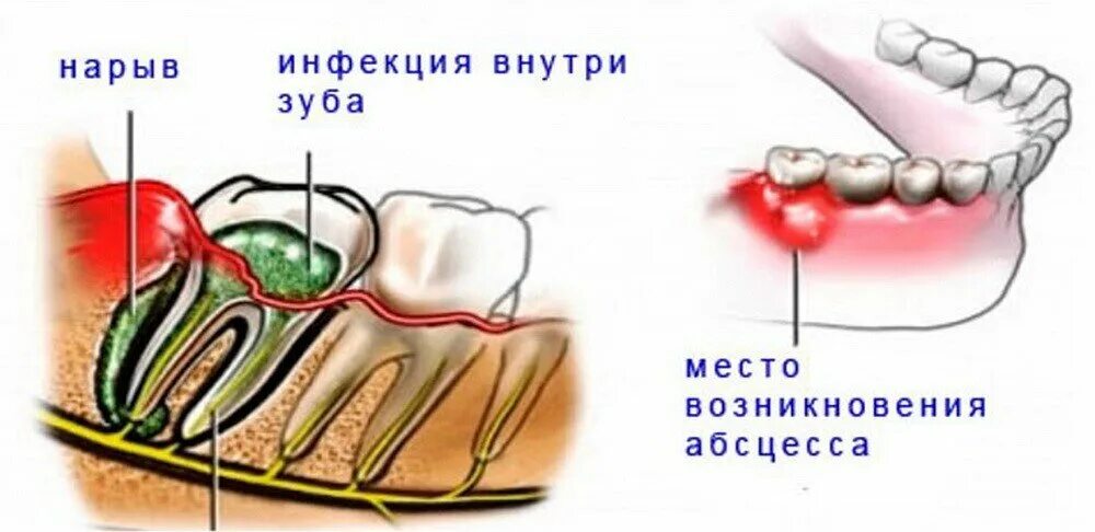 Фурункул абсцесс флегмона. Зубы болят и сверху и снизу