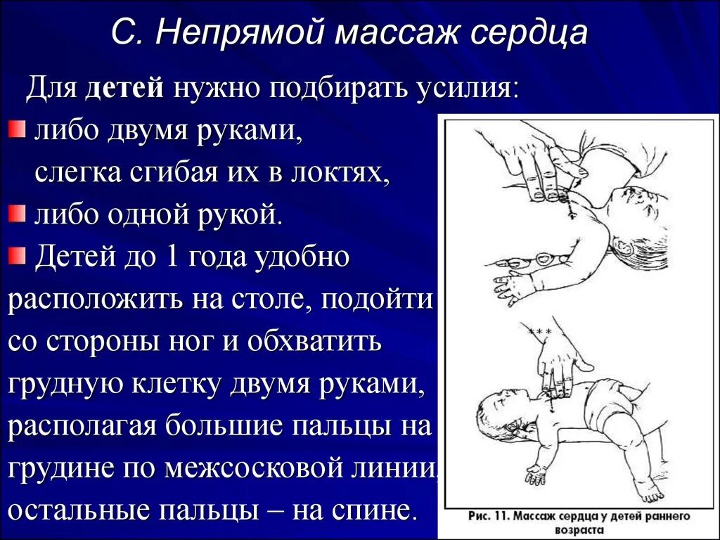 Непрямой массаж сердца схема. Наружный непрямой массаж сердца. Наружный массаж сердца схема. Методика наружного массажа сердца.