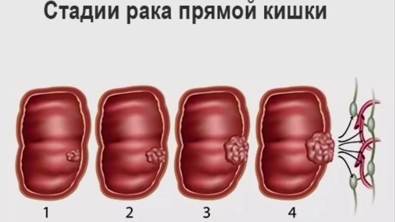 Злокачественная опухоль толстой кишки. Новообразования в прямой кишке. Онкология прямой кишки стадии