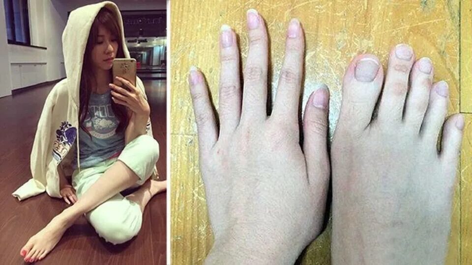 девушка без пальцев рук