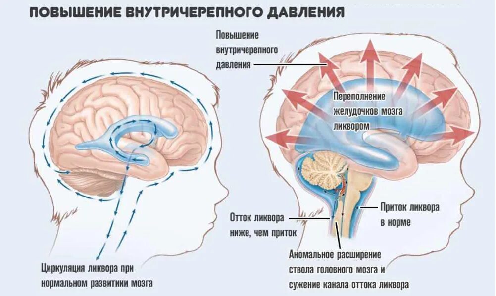 Реб 6. Повышение внутричерепного давления патогенез. Этиология синдрома повышения внутричерепного давления. Gidrocefaliya головного мозга. Синдром внутричерепной гипертензии патогенез.