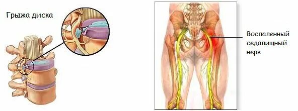 сёдалищный нерв седалищный нерв защемление. грыжа защемила седалищный нерв. ишиас воспаление седалищного нерва. грыжа защемила седалищный нерв. трансфораминальная блокада.