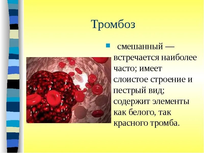 Состав тромба. Строение красного тромба. Белый красный и смешанный тромбы.