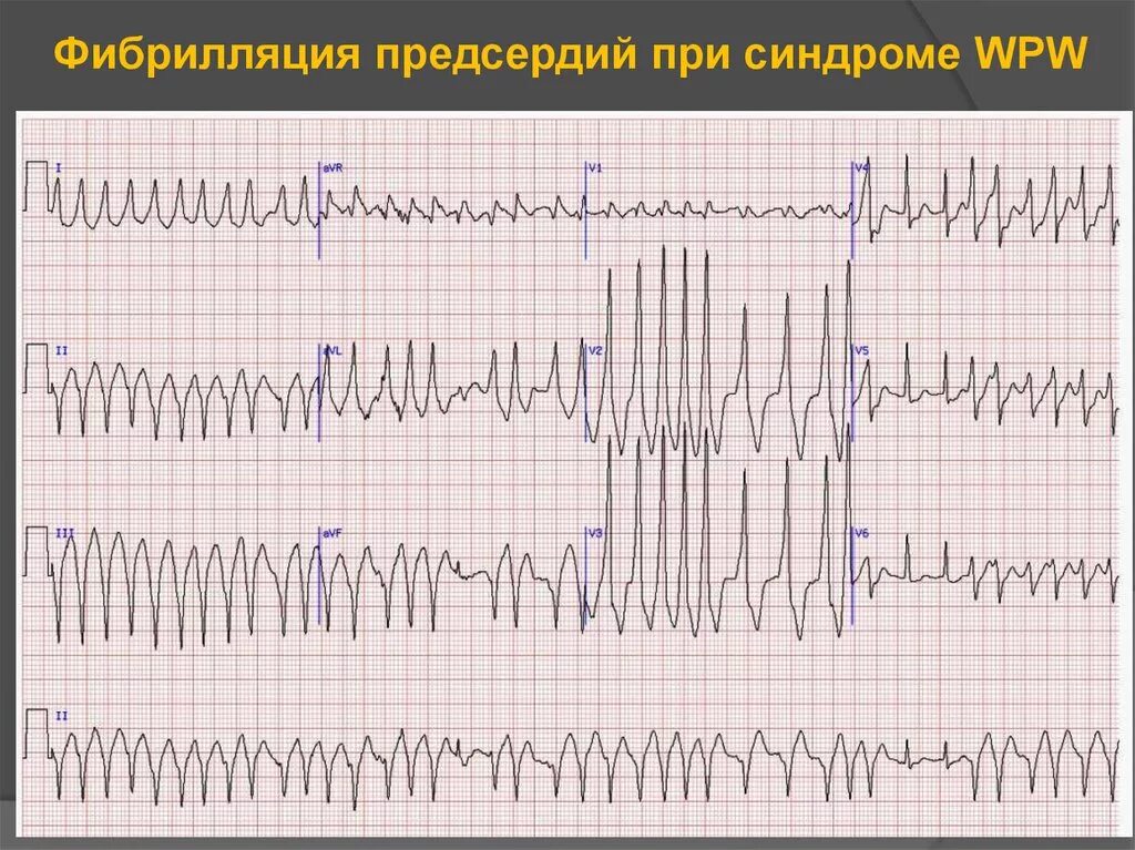 Тахисистолия это. ЭКГ при фибрилляции и трепетании предсердий. Тахиформа фибрилляции предсердий на ЭКГ. Фибрилляция предсердий wpw ЭКГ. Фибрилляция предсердий Мерцательная аритмия ЭКГ.