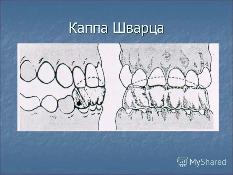 френкель 3 тип ортодонтия. функционально направляющие ортодонтические аппараты. регулятор функции френкеля 2. функционально направляющие аппараты в ортодонтии. аппарат френкеля 1 типа ортодонтия.
