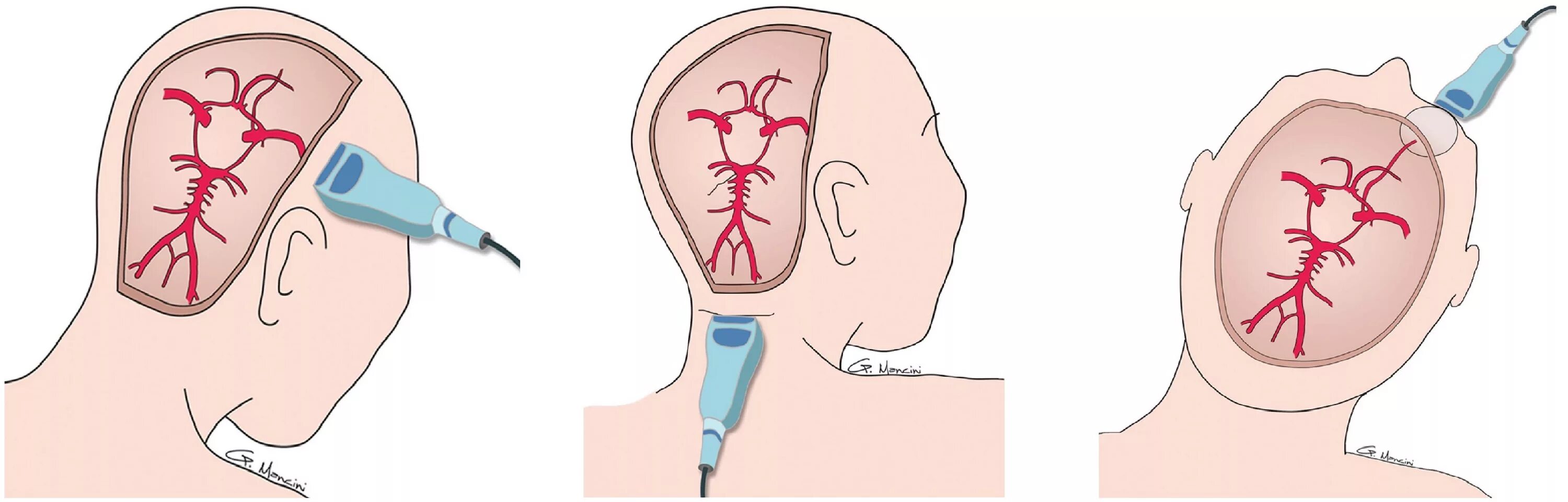 Допплерография сосудов головного мозга. Ультразвуковая допплерография сосудов головного мозга. УЗИ допплер сосудов головы. УЗИ транскраниальных сосудов. Транскраниальные артерии и вены