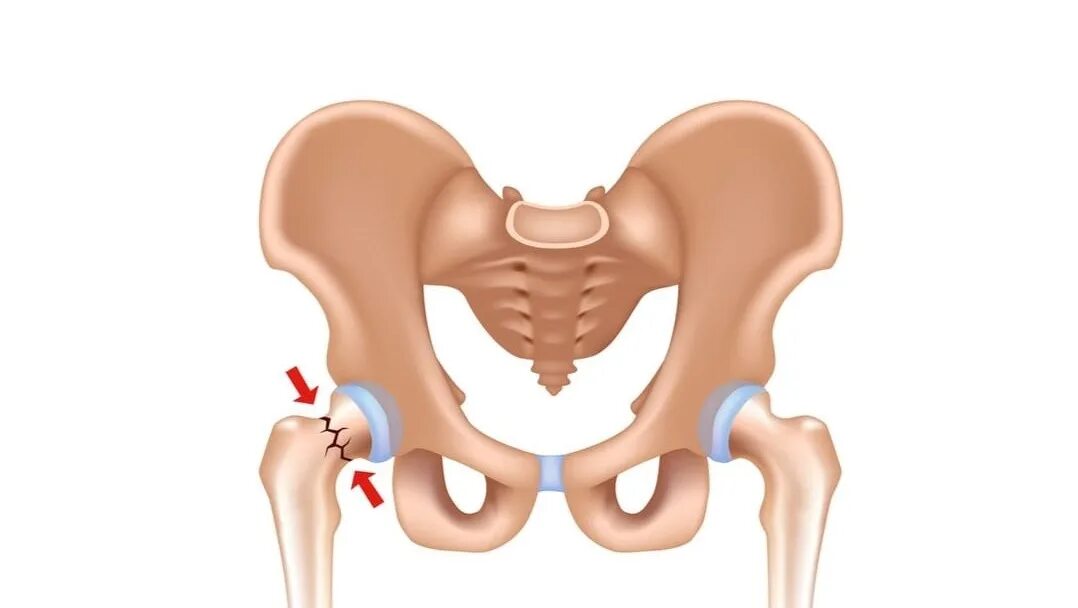 Трещина шейки бедра. Тазобедренный сустав шейка бедра. Тазобедренный перелом шейки бедра. Перелом тазобедренного сустава. Тазобедренная кость.