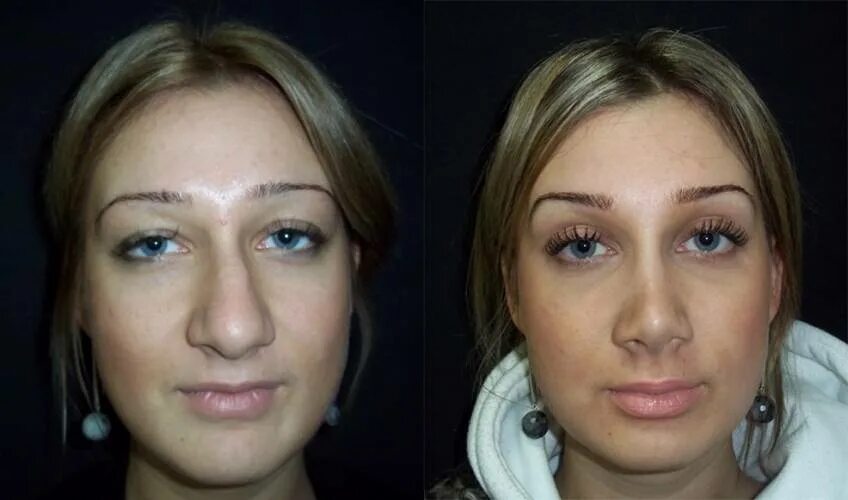 скулы до и после. бульбообразный нос ринопластика. аугментационная ринопластика. до использования лицо. биоревитализация до и после.
