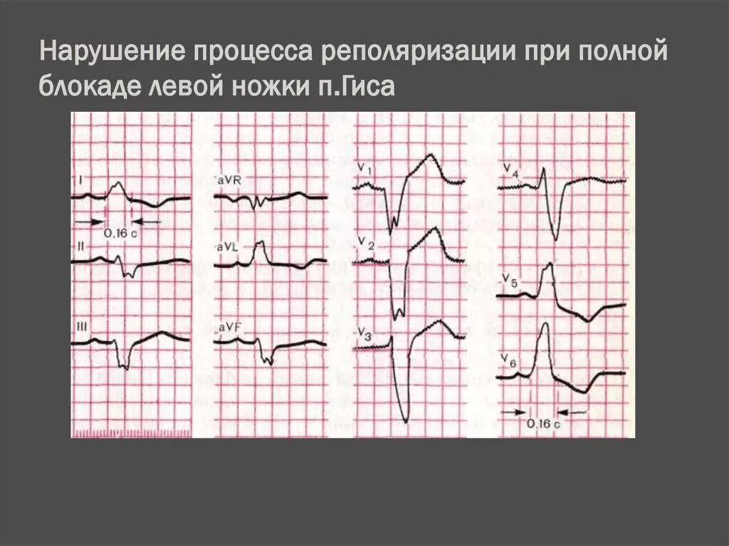 Реполяризация миокарда на ЭКГ. Синдром изменений процессов реполяризации. Нарушение реполяризации миокарда на ЭКГ. Нарушение процессов реполяризации на ЭКГ. Изменение реполяризации левого желудочка