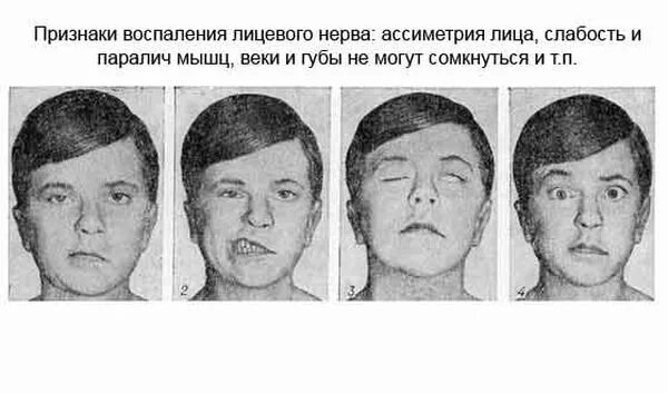 Воспаление тройничного лицевого симптомы. Неврит лицевого нерва симптомы. воспаление лицевого нерва симптоматика. неврит воспаление лицевого нерва. неврищм лицевого нерва.