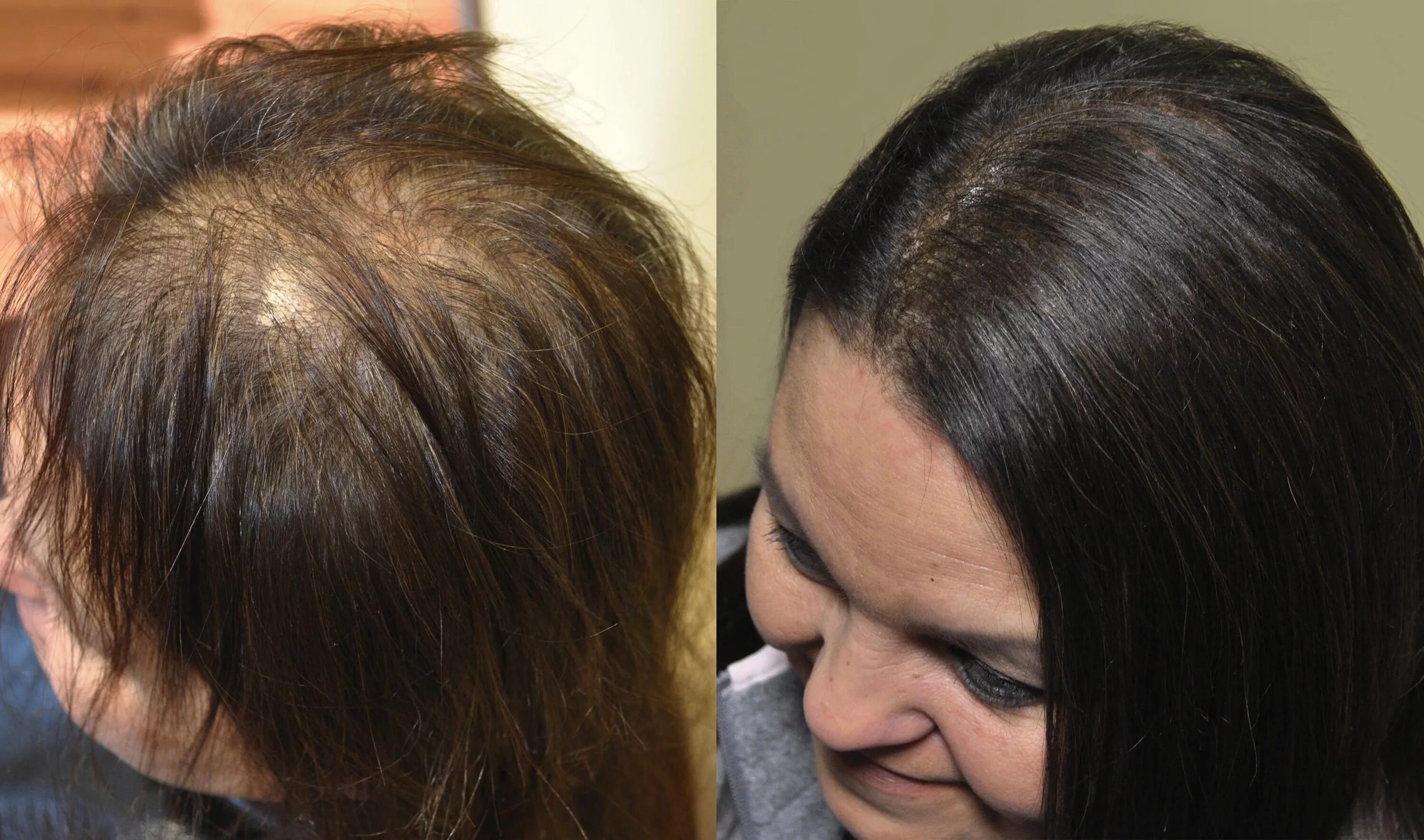 Восстановление выпадения волос. Выпадение волос алопеция.