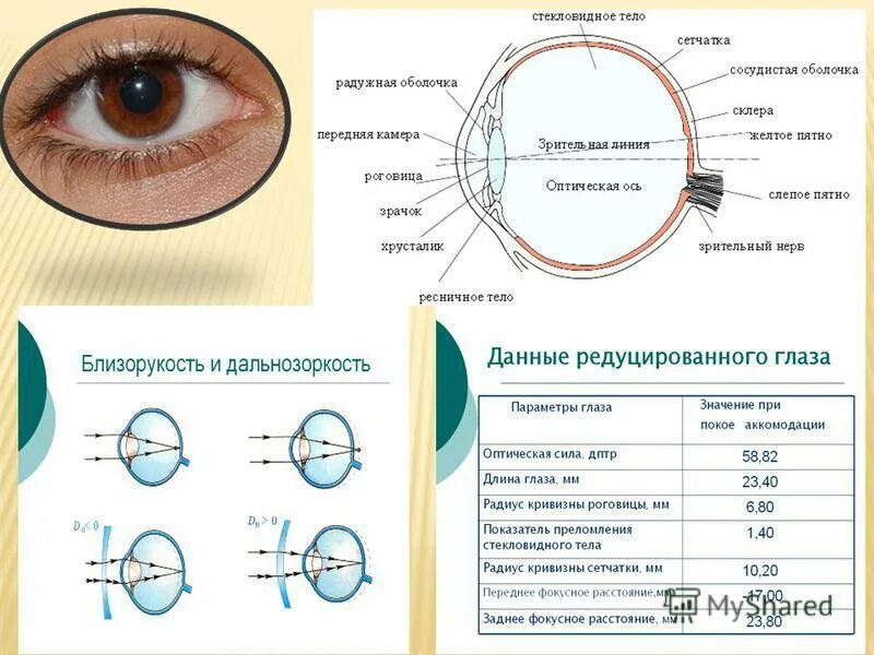 Средний размер глаз. Строение глаза дальнозоркость с линзой. Миопия и гиперметропия линзы. Дальнозоркость и близорукость строение глаза. Кривизна линз 8.6.