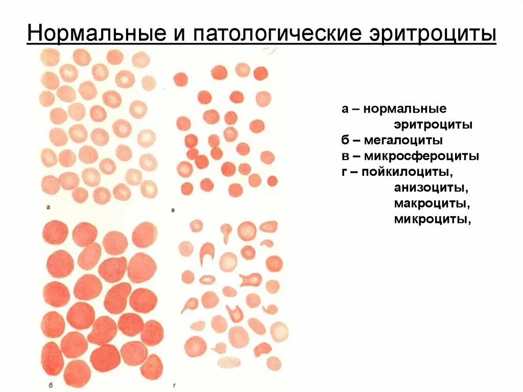 Микроциты повышены. Патологические формы эритроцитов при различных анемиях. Патологические формы эритроцитов периферической крови. Микроцитоз анизоцитоз пойкилоцитоз. Эритроциты при анемии.