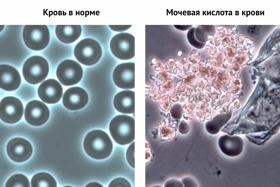 Кислота в крови повышена причины симптомы. Мочевая кислота. Соли мочевой кислоты в крови. Кристаллы мочевой кислоты в крови. Мочевинная кислота в крови.