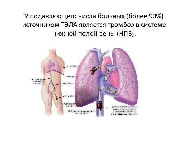 Причины возникновения тромбоза. Тромбоэмболия легочной артерии Триада Вирхова. Нижняя полая Вена тромбоз. Триада Вирхова тромбоз. Тромб нижней полой вены.