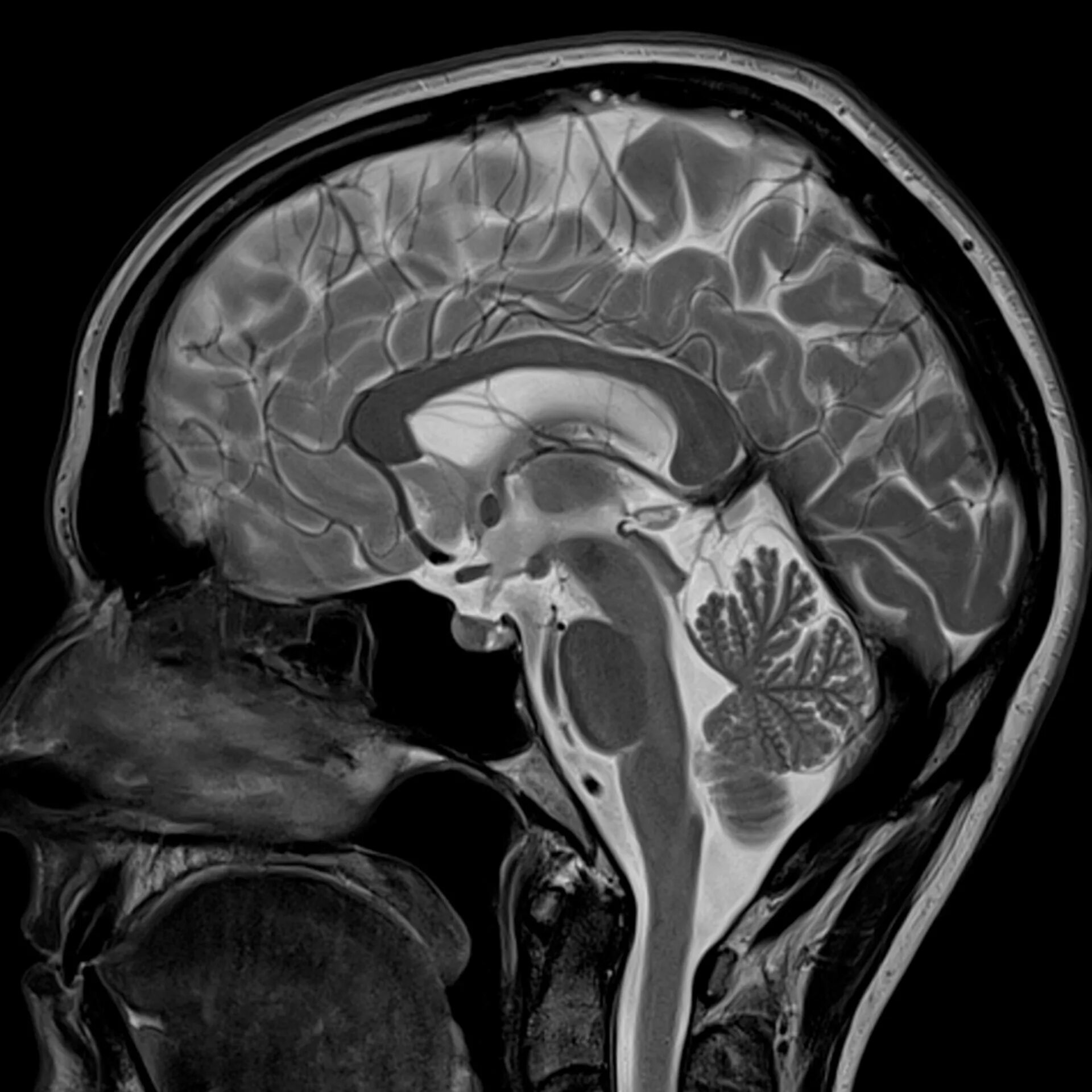Ликвородинамика головного мозга мрт. Сагиттальный срез ГМ мрт. Кт томограмма головного мозга. Кт головного мозга в сагиттальной проекции.