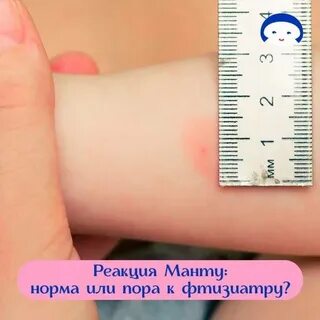 Норма после манту