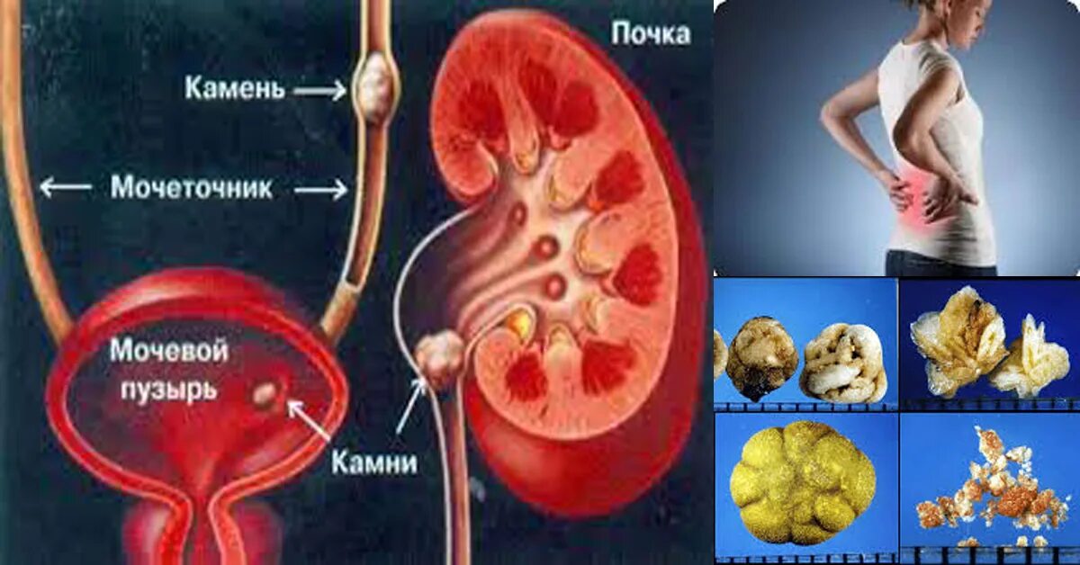 Камень больно. Камни в почках и мочевом пузыре. Процесс камнеобразования в почках. Камни в почках, мочеиспускательной системы. Камни из почек в мочевой пузырь.