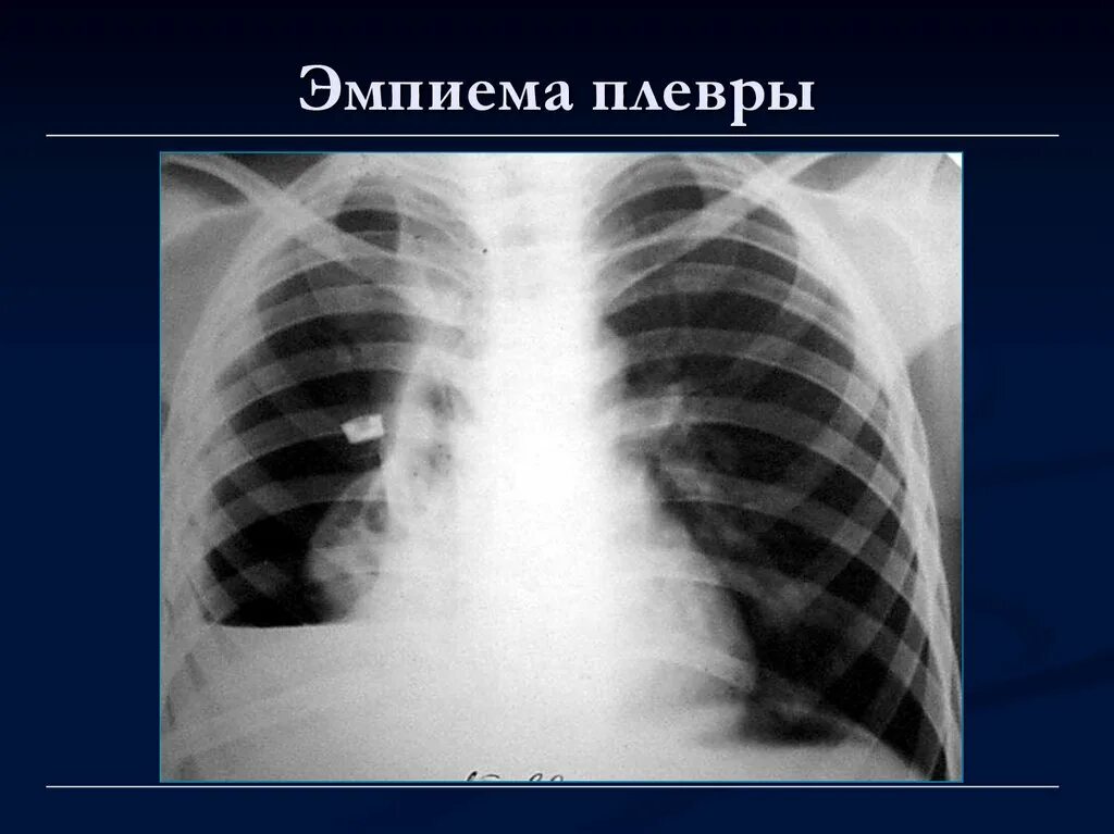 Эмпиема легкого. Острый Гнойный плеврит рентген. Острый Гнойный плеврит и эмпиема плевры. Гнойный плеврит эмпиема плевры. Плеврография при эмпиеме плевры.