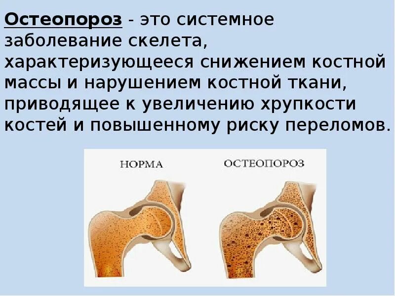 Профилактика остеопороза картинки. Рентген здоровой пяточной кости. Остеопороз пяток. Остеопороз это заболевание. Пятнистый остеопороз костей рентген.