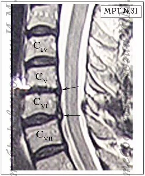 Сегменты с5 с6. Межпозвонковые диски c5 c6 c7. Протрузии дисков с5-с6 и с6-с7. Протрузия межпозвонкового диска с4/5, с5/6, с6/7. Протрузии дисков c4/c5 c5/c6 c6/c7.