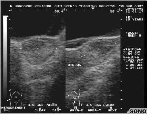 Сальпингоофорит по узи. Оофорит что. Воспаление яичника и маточной трубы. Оофорит воспаление яичников симптомы. Воспаление яичников на узи.