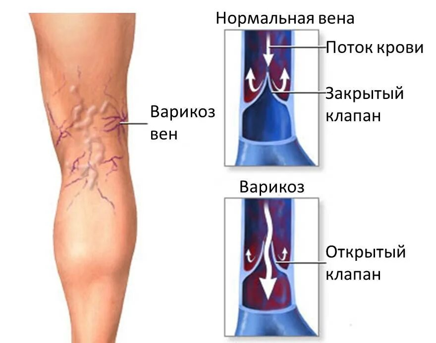 Тромбы в сосудах причины