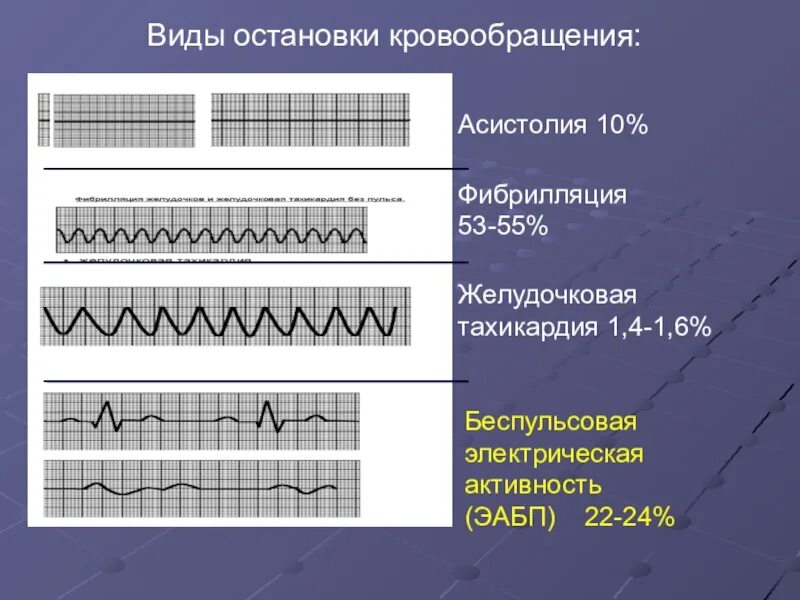 Варианты остановки кровообращения. Асистолия фибрилляция желудочков электромеханическая диссоциация. Электрическая активность без пульса на ЭКГ. ЭКГ ритмы внезапной остановки кровообращения. Асистолия и фибрилляция на ЭКГ.