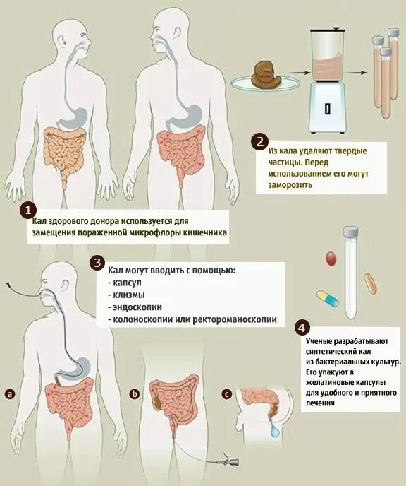 Почему подсаживают. Пересадка микробиоты кишечника. Трансплантация фекальной микрофлоры. Трансплантация фекального микробиота.