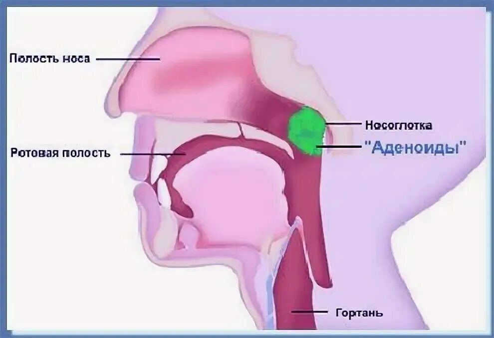 Аденоиды носоглоточные миндалины. Небные миндалины и аденоиды. Разрастание носоглоточной миндалины. Аденоиды у детей снимки.