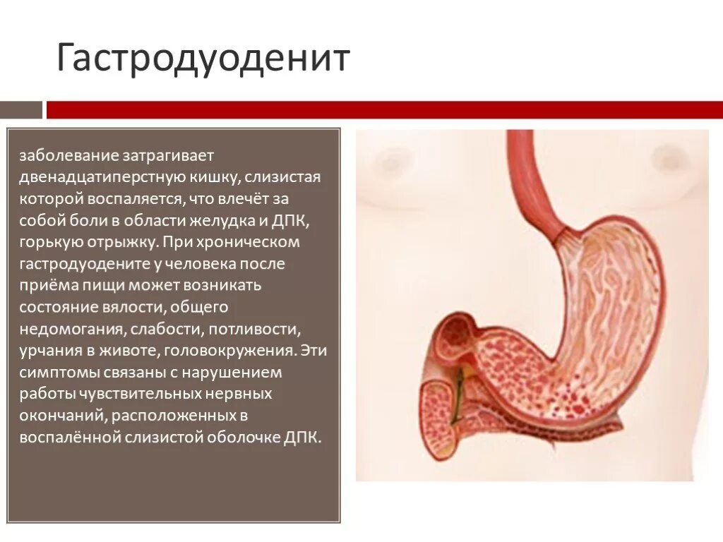 Может ли гастродуоденит