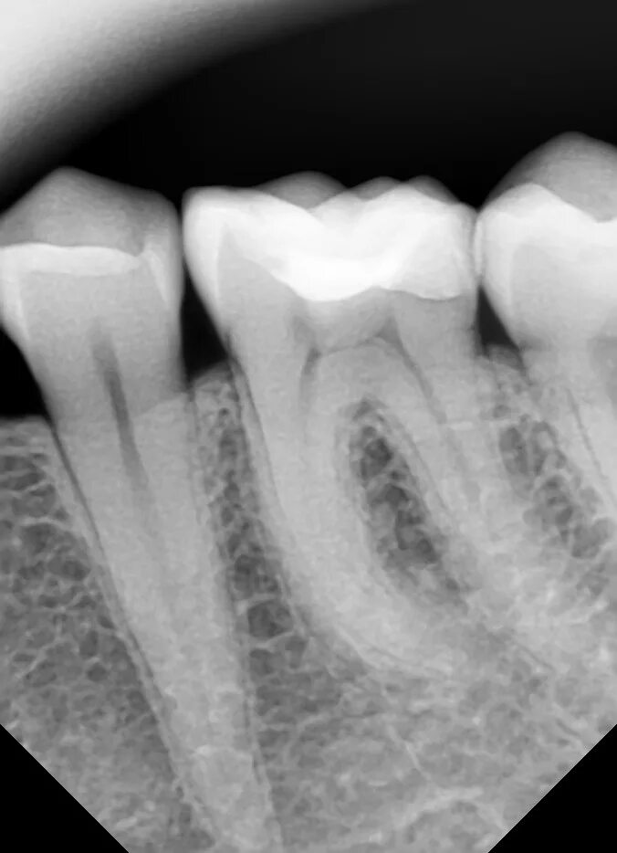 Снимок зубов видное. Периапикальный периодонтит. Апикальный периодонтит рентген. Периапикальный пародонтит.