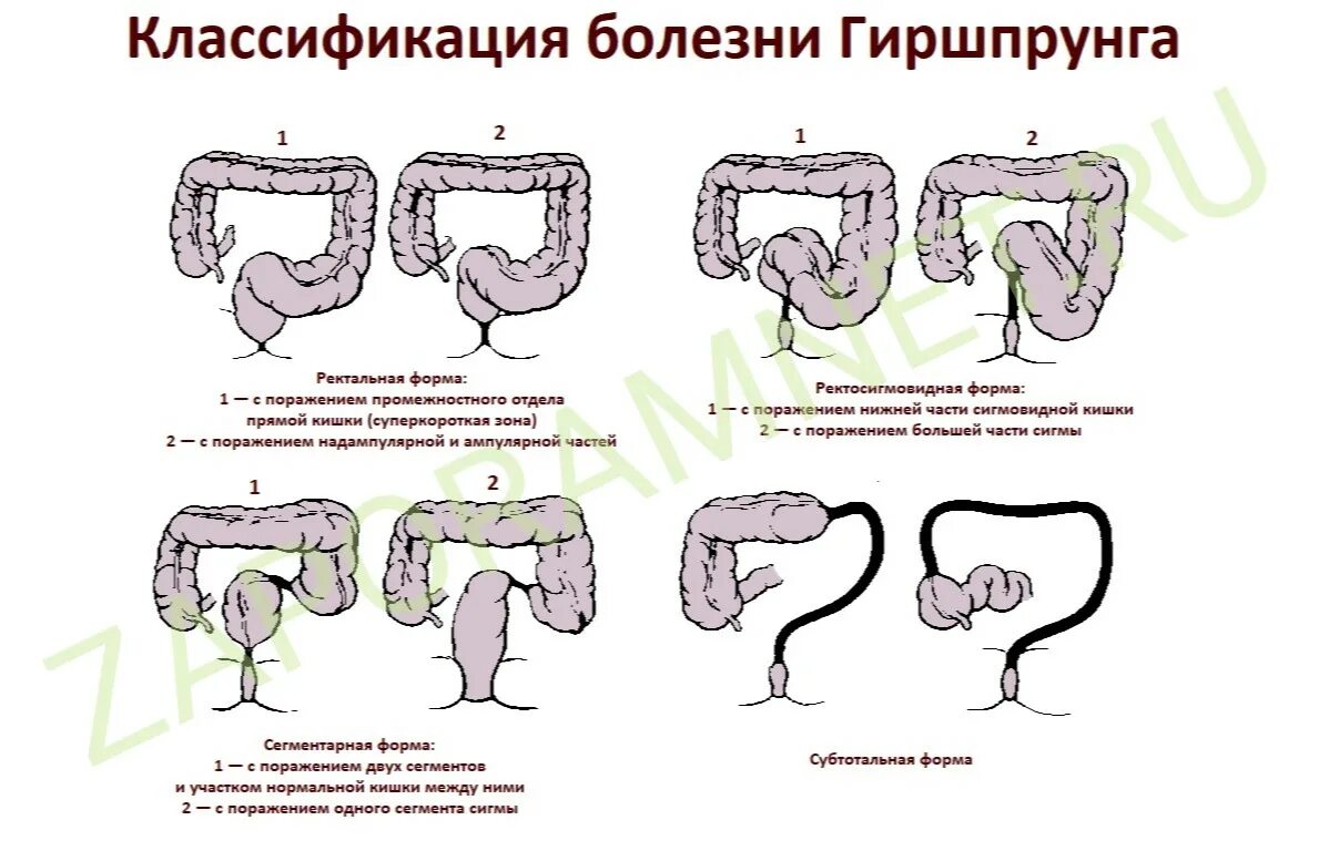 Анатомическая классификация болезни Гиршпрунга. Анатомические формы болезни Гиршпрунга. Мегаколон болезнь Гиршпрунга. Непроходимость Гиршпрунга. Дисплазия низкой степени толстой кишки что это