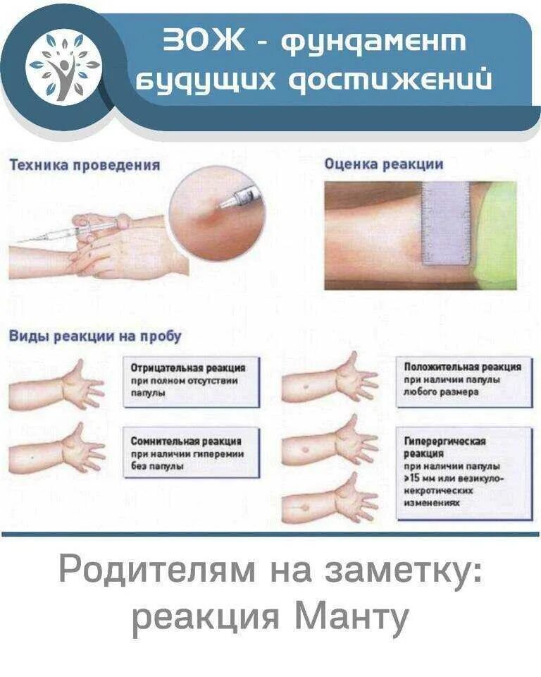 Манту что нельзя делать после прививки. Туберкулиновая проба реакция манту. Туберкулез кожно аллергические проба манту. Проба манту реакция положительная папула 10мм. Проведение пробы реакции манту.