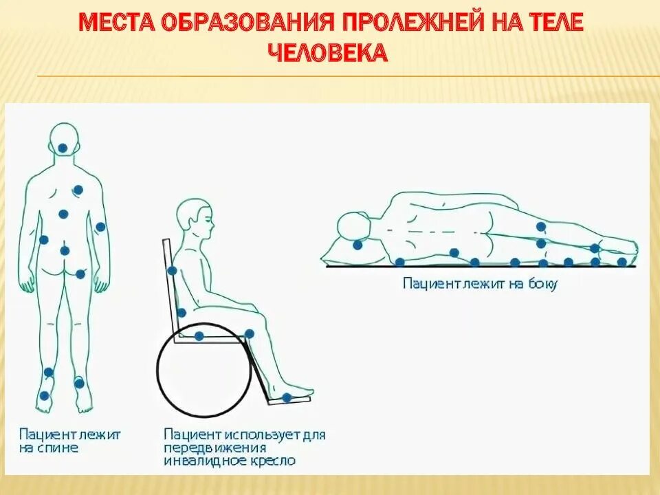 Пролежни в положении на боку. Пролежни места образования пролежней. потенциальные места развития пролежней. зоны риска образования пролежней. места возможного образования пролежней в положении сидя.