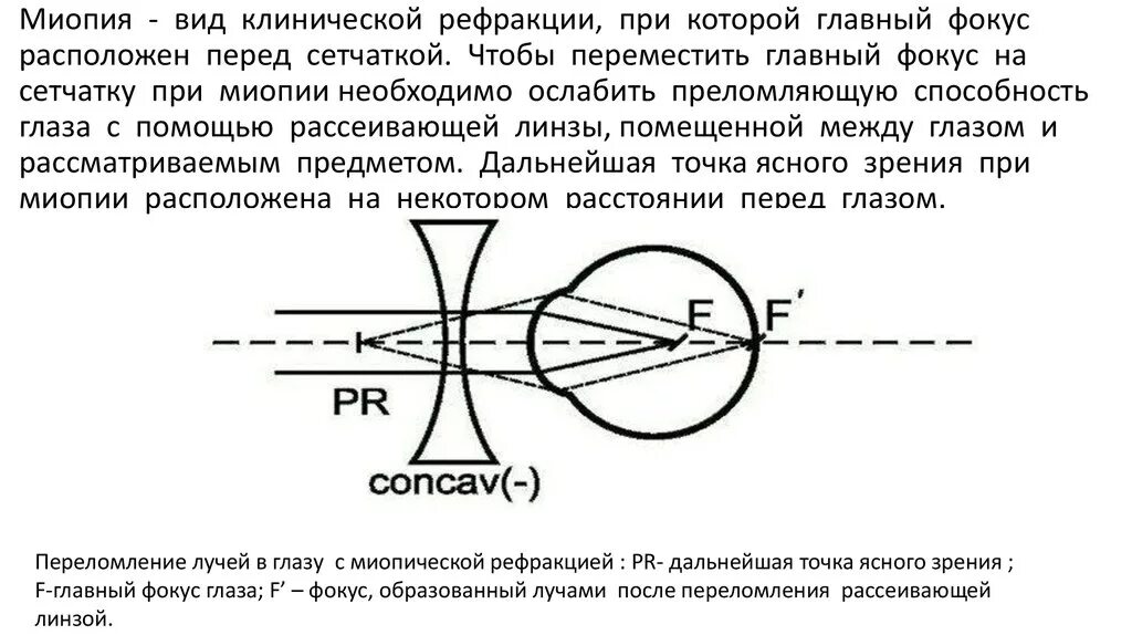 Миопия фокус перед сетчаткой. Ход лучей при различных видах клинической рефракции глаз. Рефракция миопия. Миопическая рефракция. Перед сетчаткой расположена