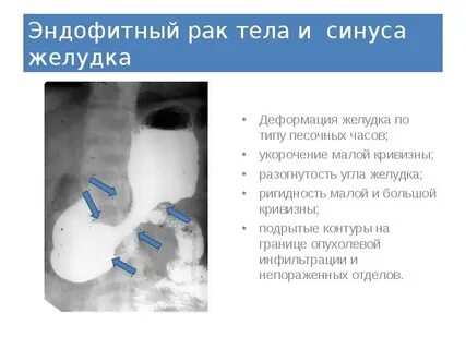 Каскадный желудок