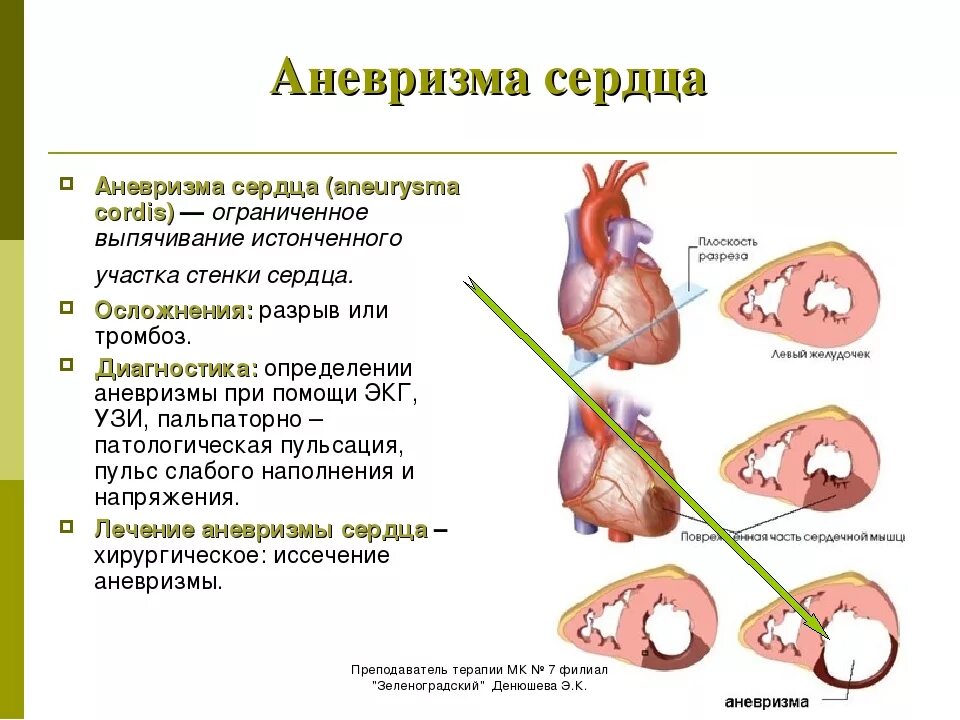 Аневризма сердца что это такое симптомы. Острая аневризма сердца патанатомия. Хроническая аневризма сердца. Патогенез аневризмы сердца. Острая и хроническая аневризма сердца.