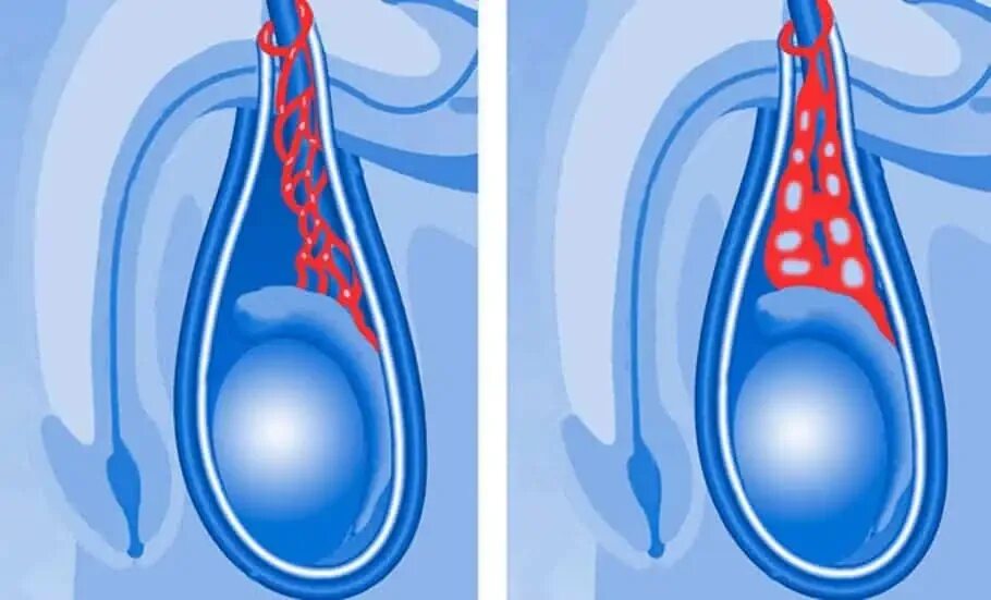 Расширение семенной вены. Варикоцеле-расширение вен семенного канатика яичка. Варикоз вен семенного канатика. Варикоцеле – расширение вен семенного канатика.