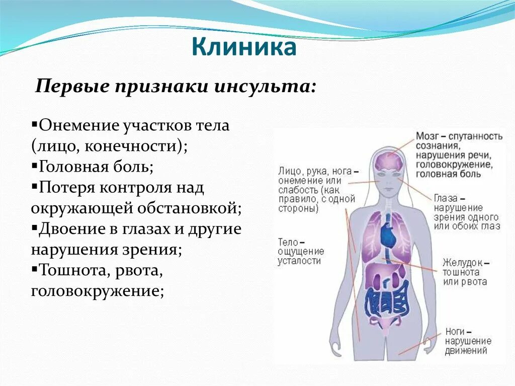 Клиника инсульта. Инсульт головокружение и тошнота. Онемение одной половины тела. Онемение всего тела причины. Инсульт правая сторона тела