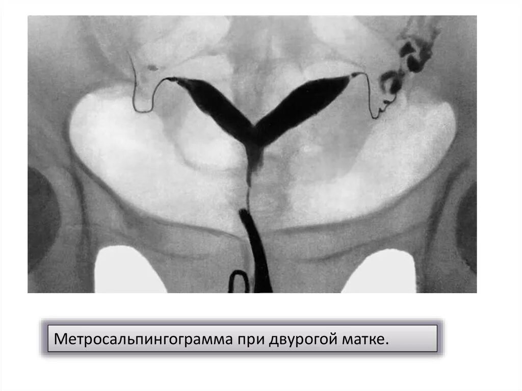 Гистеросальпингография двурогая матка. Двурогая матка рентген. Двурогая матка операция. Что такое двурогая матка