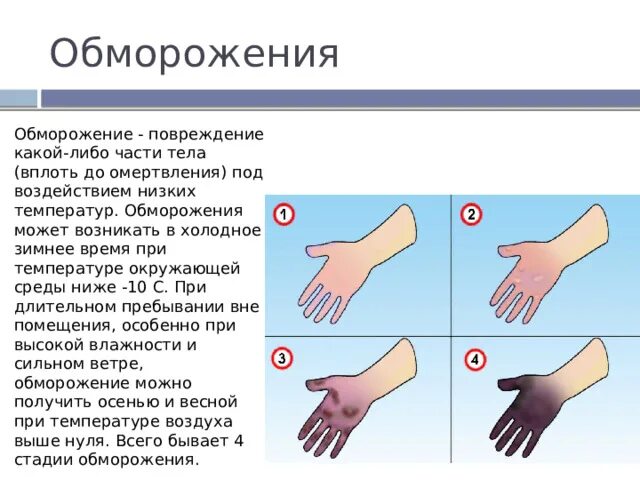 Обморожение: факторы и симптомы - Цивильская ЦРБ