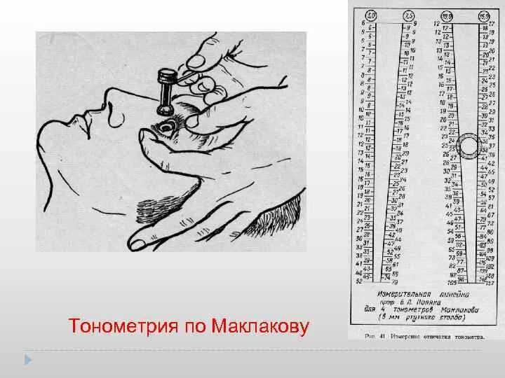 Маклаков внутриглазного давления. Тонометрия по маклакову (измерение внутриглазного давления). Измерение внутриглазного давления тонометром Маклакова. Алгоритм измерения внутриглазного давления по маклакову. Тонометрия метод Маклакова.