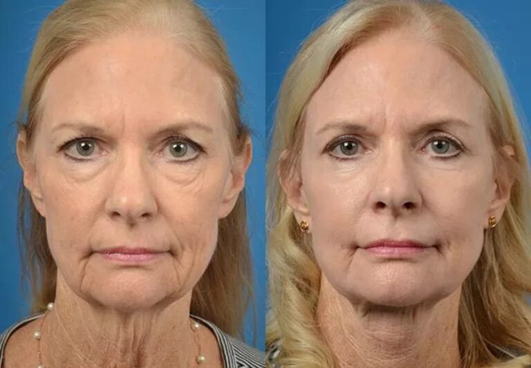 Подтяжка лица до и после. Коррекция овала лица филлерами. Лифтинг до и после. Операции после 70 лет
