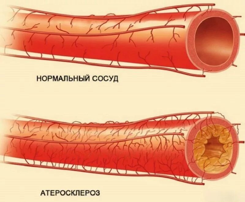 Распад сосудов. Атеросклероз коронарных артерий симптомы. Атеросклероз венечных артерий сердца. Атеросклероз сосудов брахиоцефальных артерий. Нормальный сосуд и Атеросклерозный сосуд.