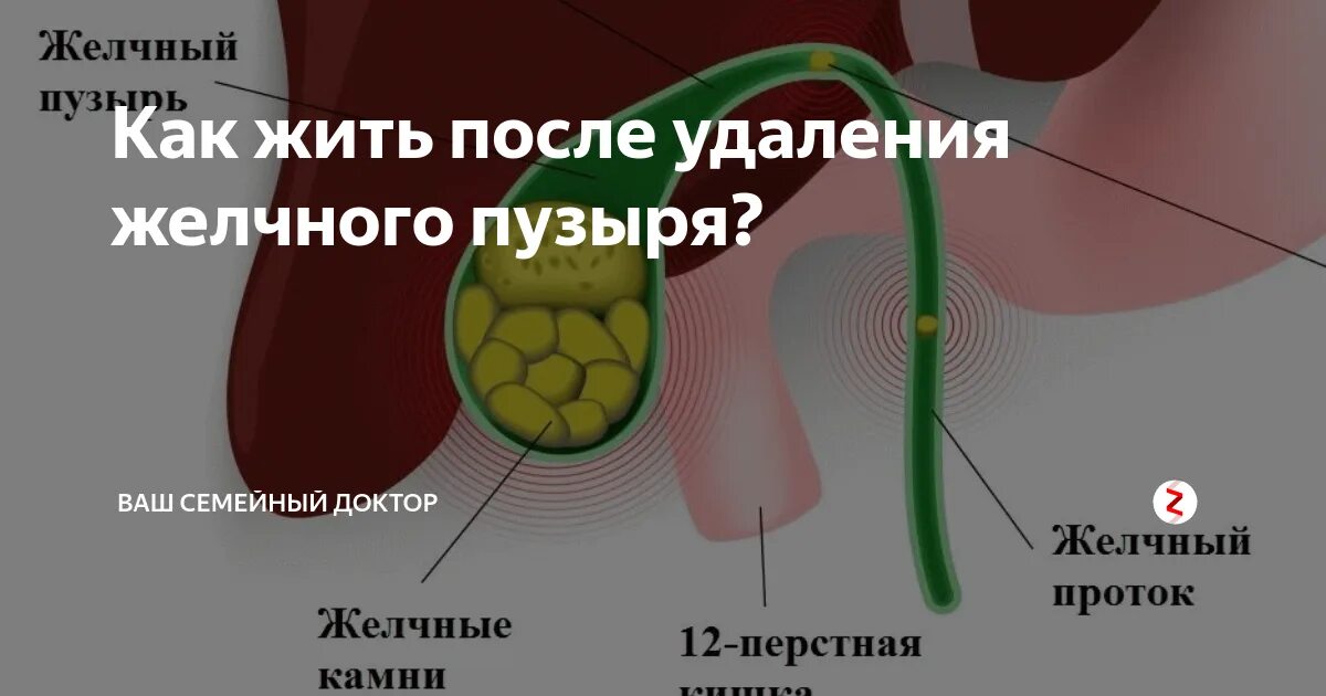 Как жить без желчного отзывы. Удаленный желчный пузырь. Операция на желчный пузырь. Отключенного желчного пузыр. Резекция желчного пузыря.